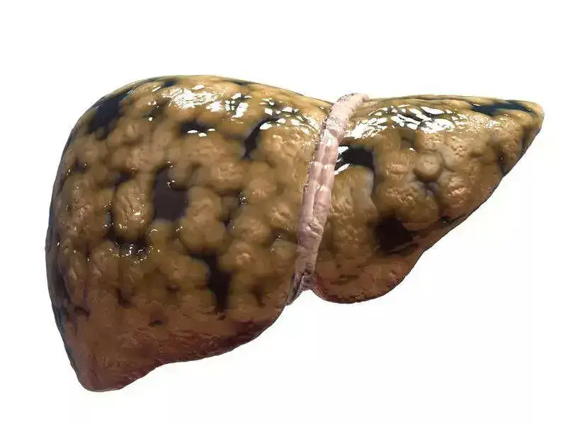 Fatty Liver