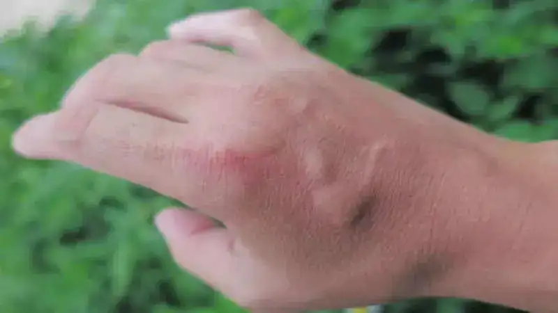 How to soothe an ant bite rash? Here are simple hacks