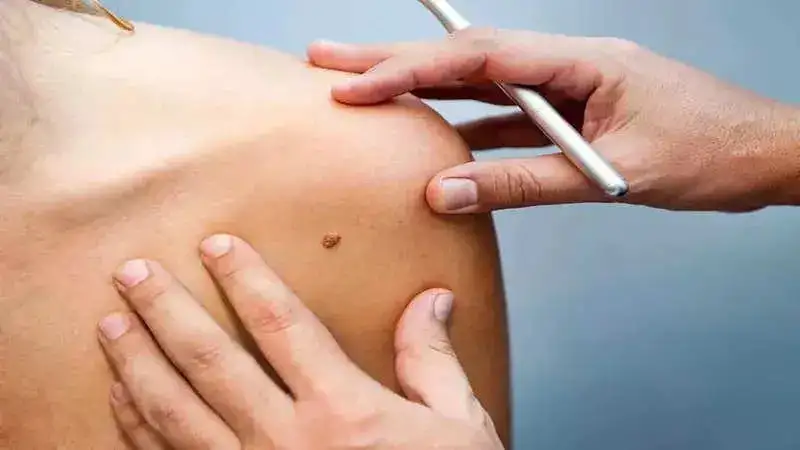 What are cancerous moles? Know about melanoma symptoms, causes and treatments