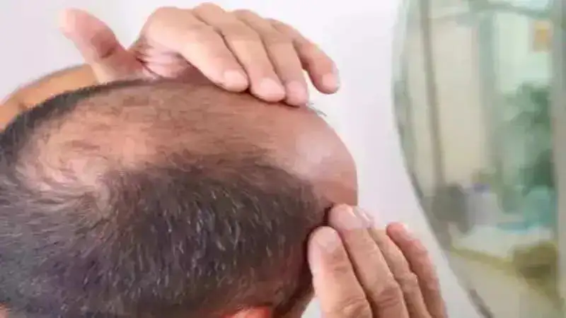 5 Natural remedies to reverse balding