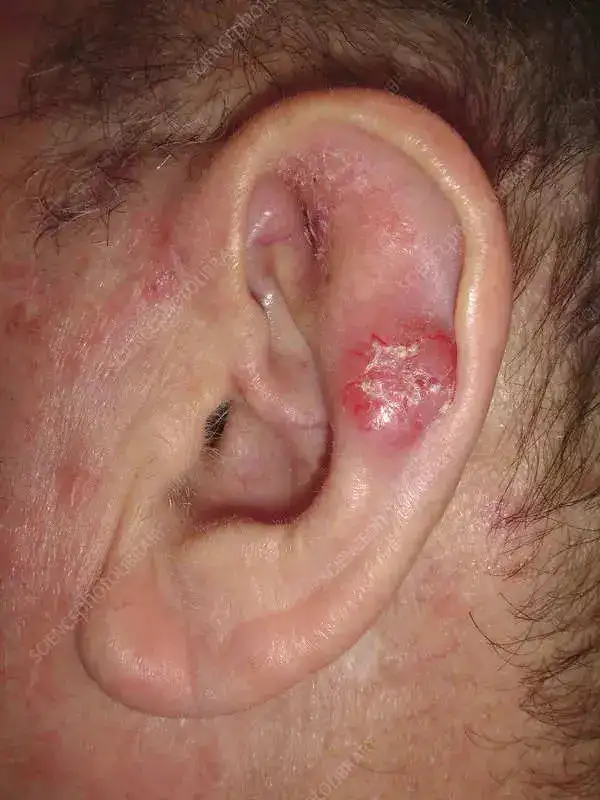 skin cancer on ears