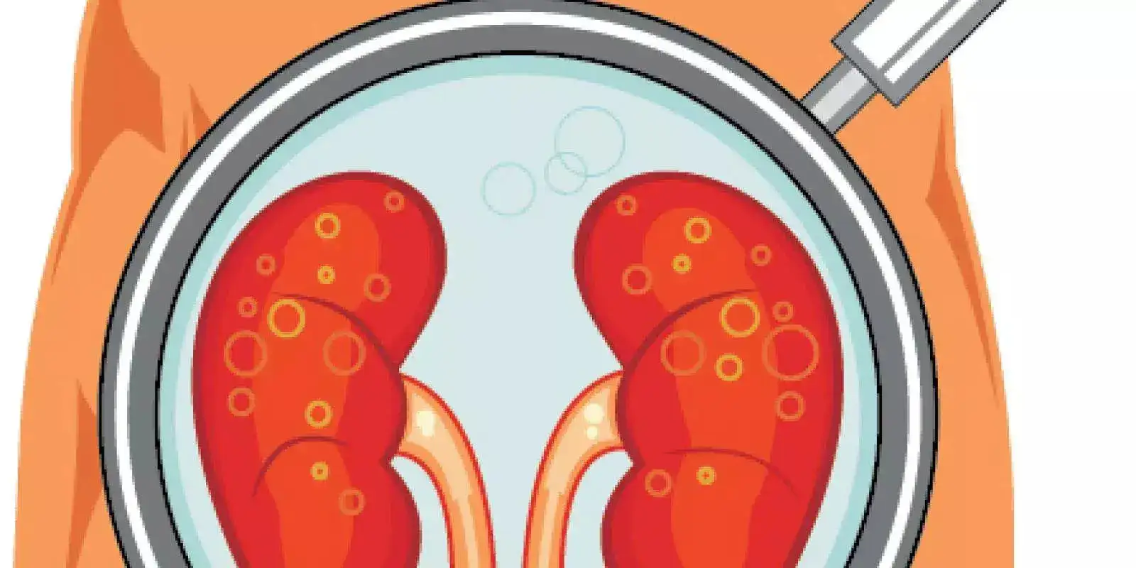 Glomerulonephritis