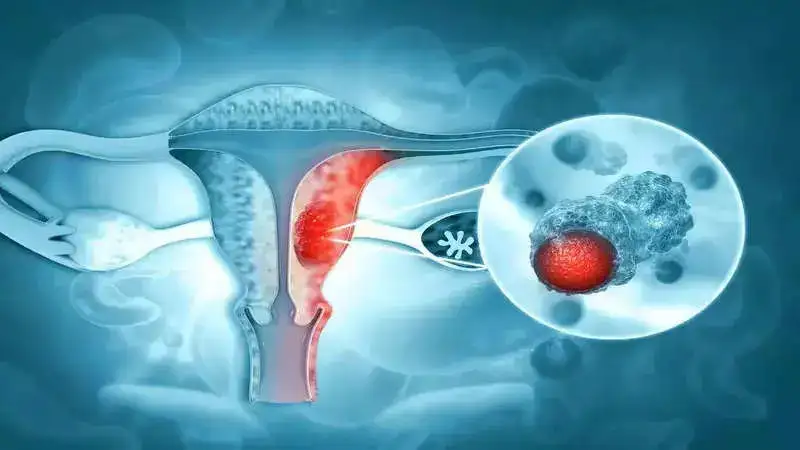 World Ovarian Cancer Day: Some must-know myths and facts about this gynaecological cancer