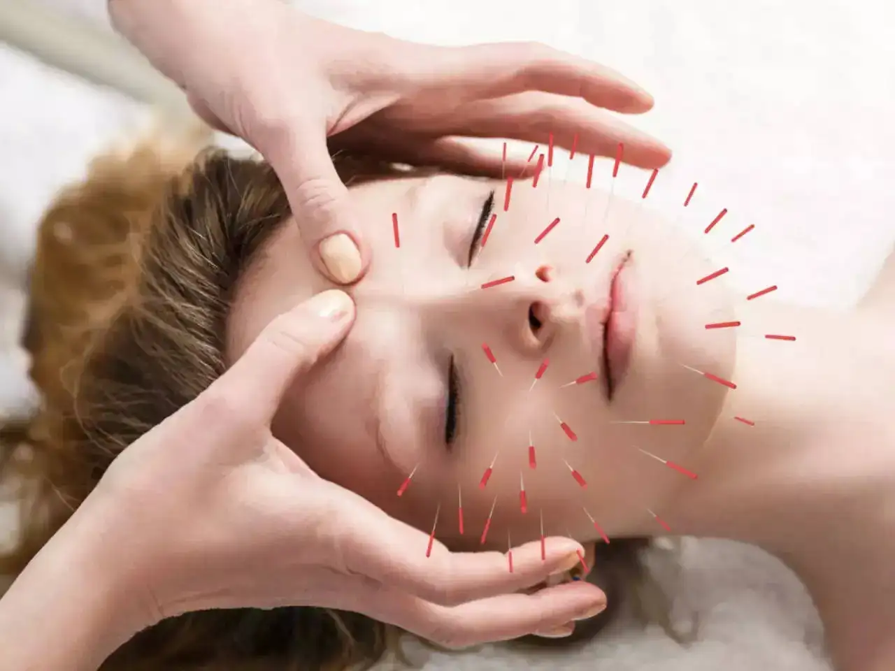 A young woman receiving facial acupuncture treatment