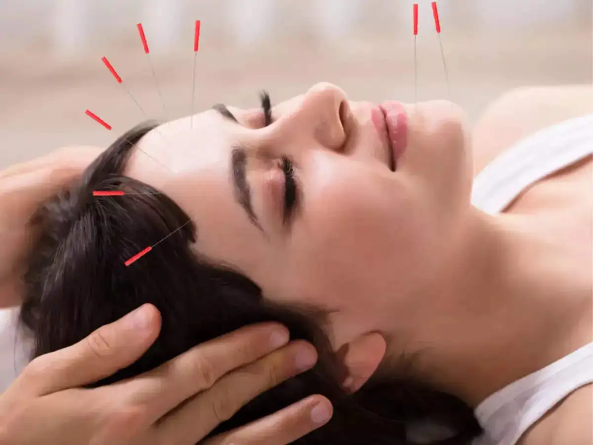 A female undergoing a facial acupuncture session