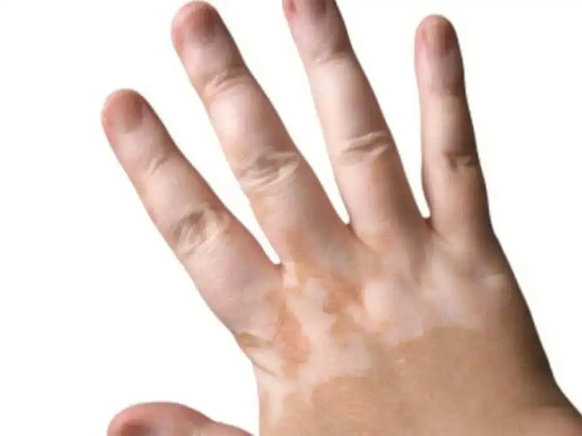 vitiligo