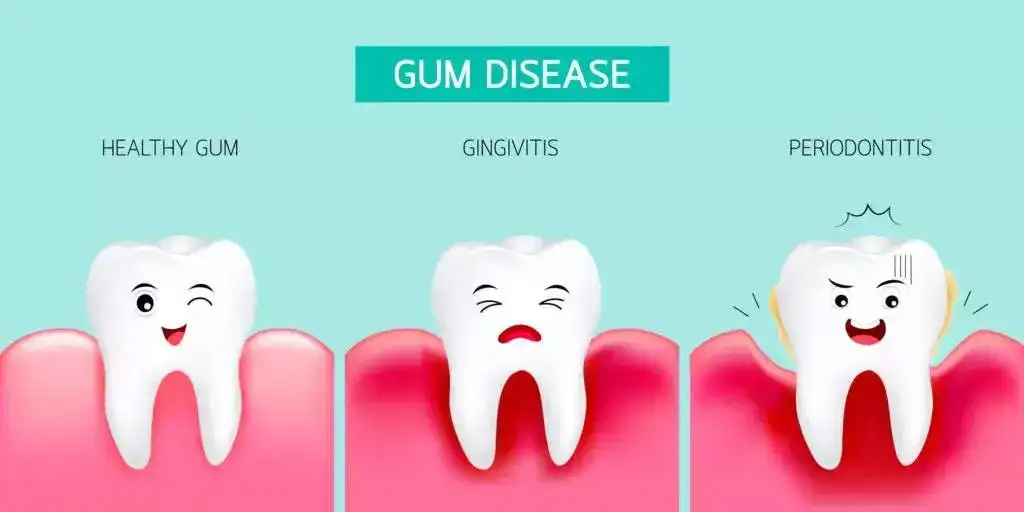 Gum Disease