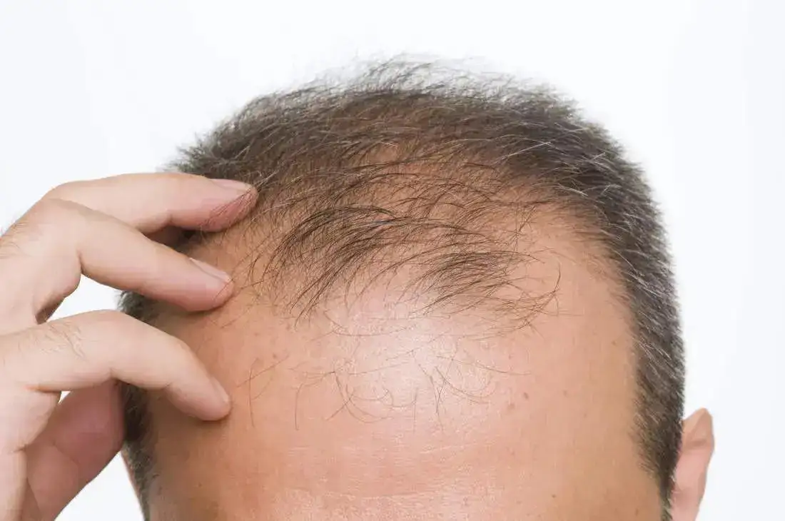 hair loss