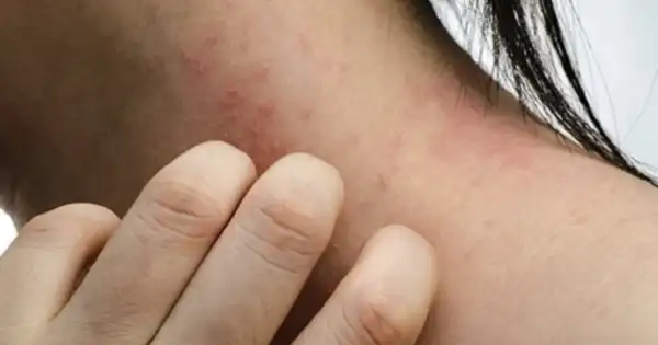 Skin Irritation