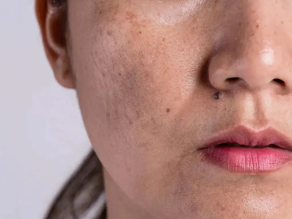 Post-inflammatory hyperpigmentation