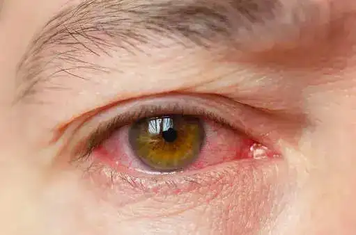 conjunctivitis.