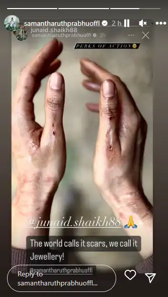 samantha hand injury junaid